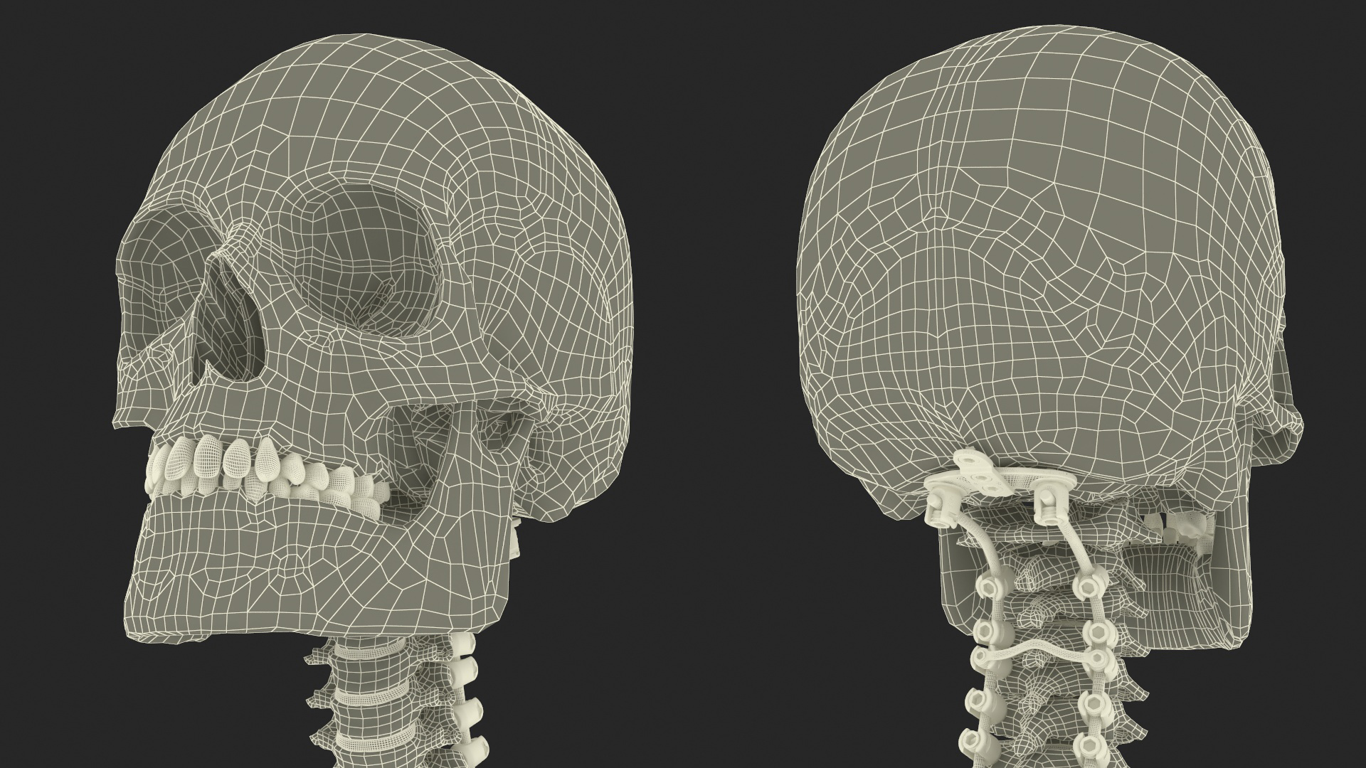 3D Bone Skull and Cervical Spine Fixation model