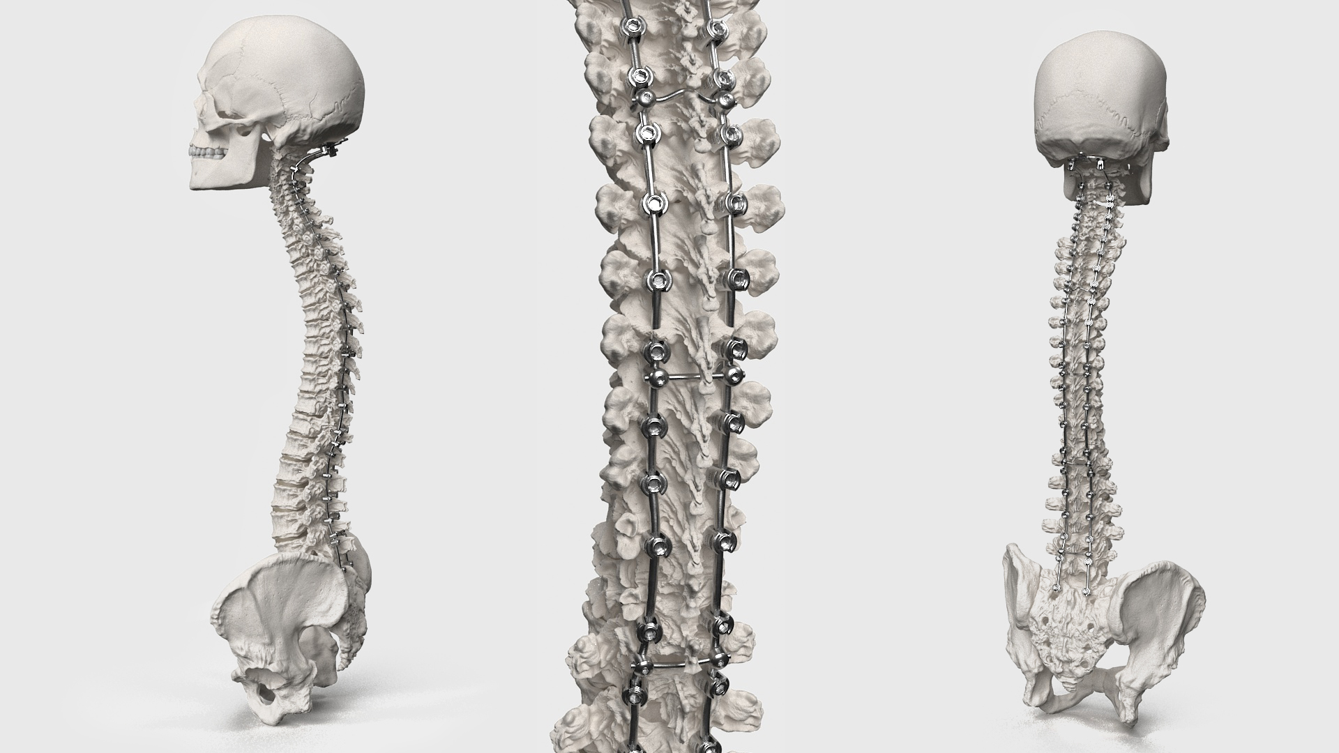 3D Bone Skull and Cervical Spine Fixation model