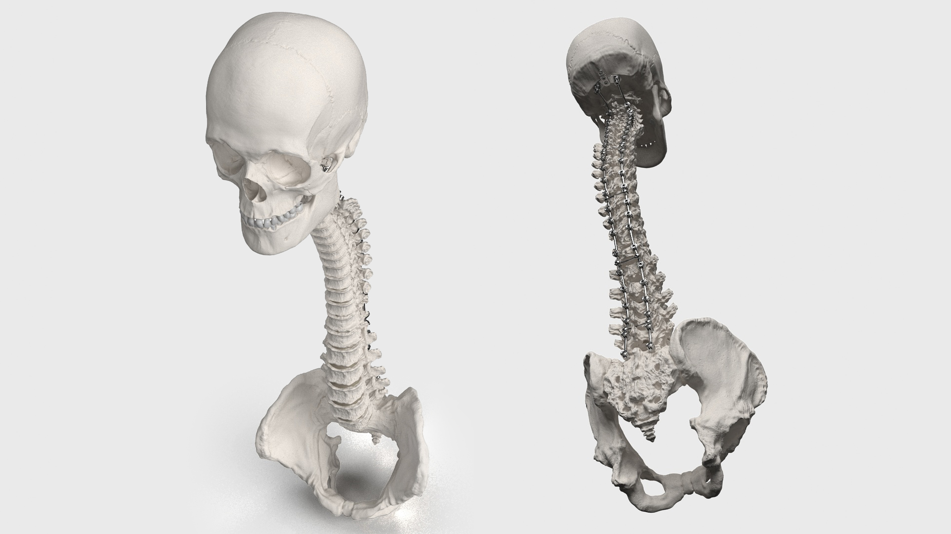 3D Bone Skull and Cervical Spine Fixation model