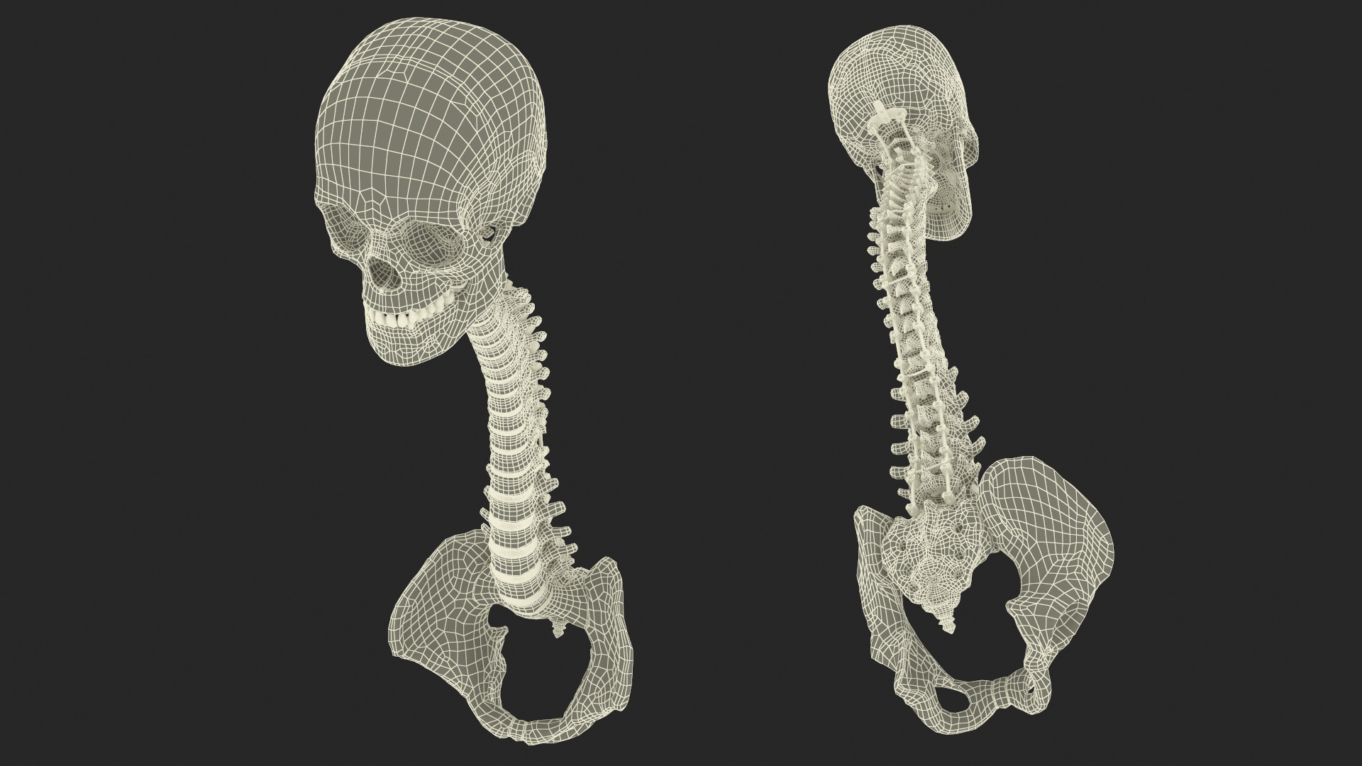3D Bone Skull and Cervical Spine Fixation model