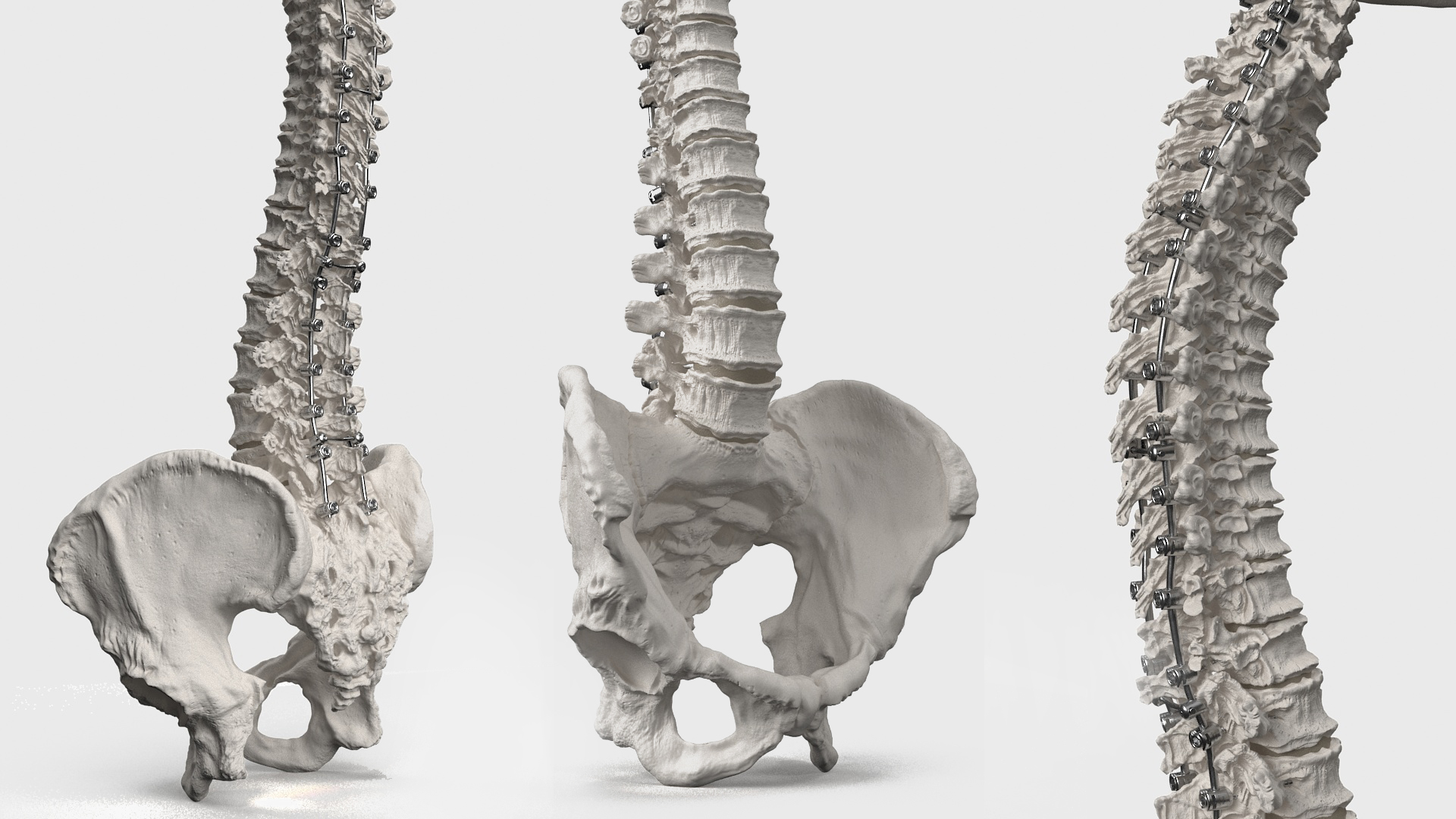 3D Bone Skull and Cervical Spine Fixation model