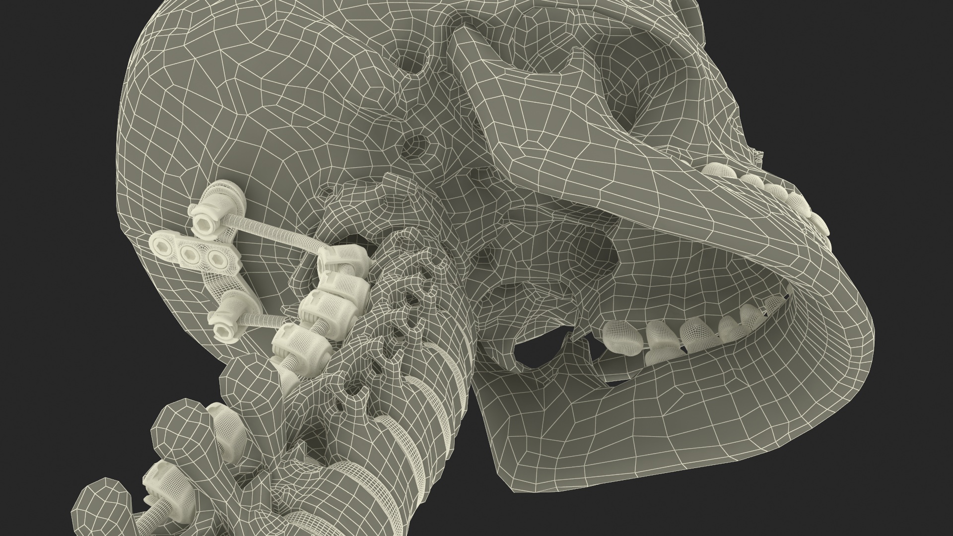 3D Bone Skull and Cervical Spine Fixation model