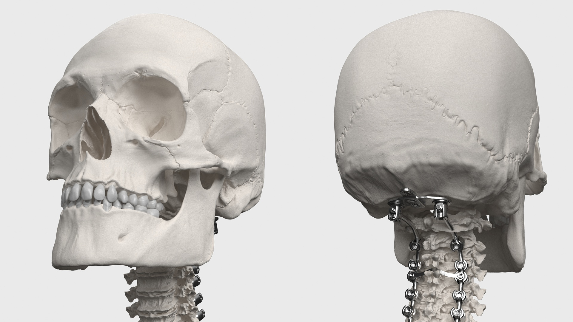 3D Bone Skull and Cervical Spine Fixation model