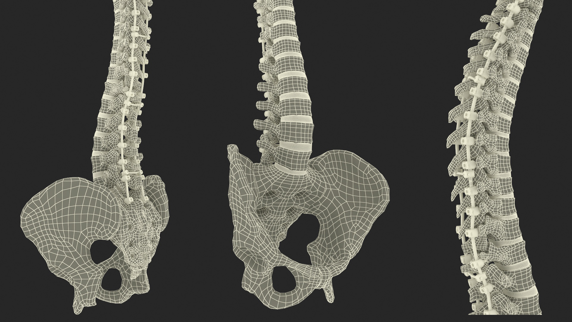 3D Bone Skull and Cervical Spine Fixation model