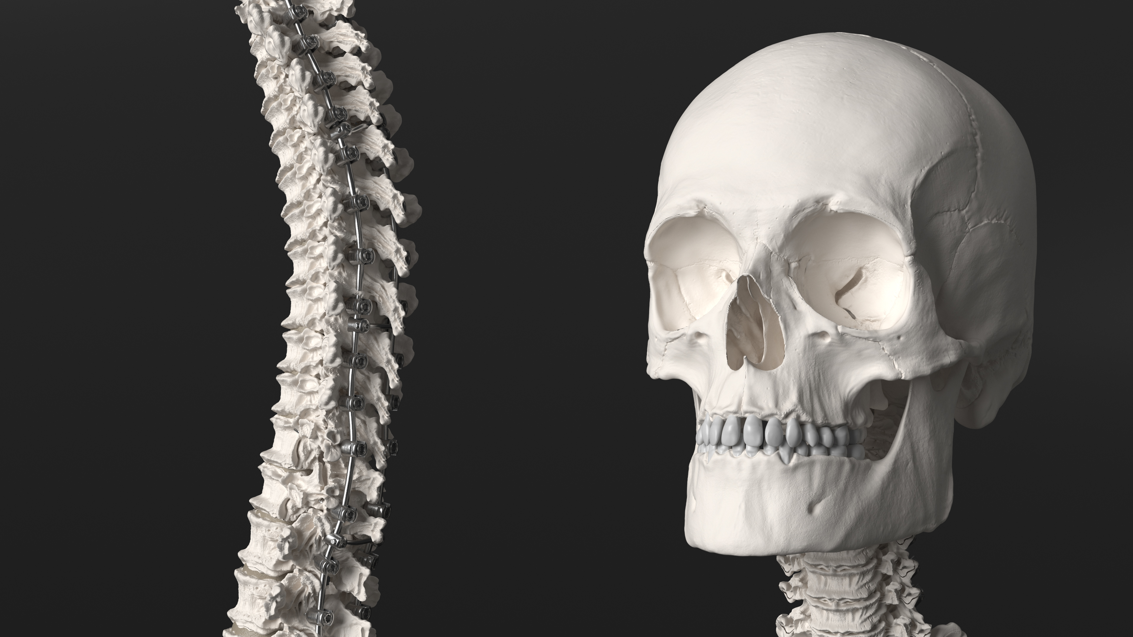 3D Bone Skull and Cervical Spine Fixation model