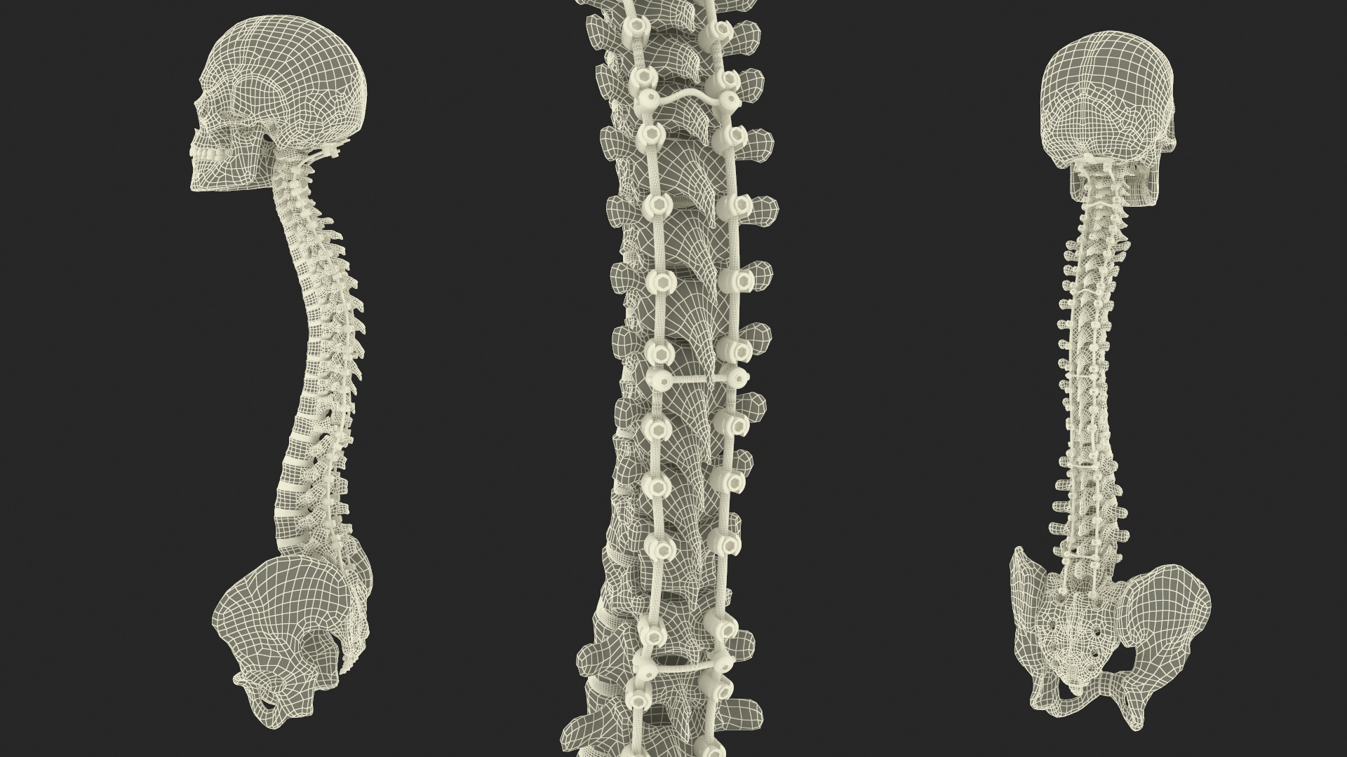 3D Bone Skull and Cervical Spine Fixation model