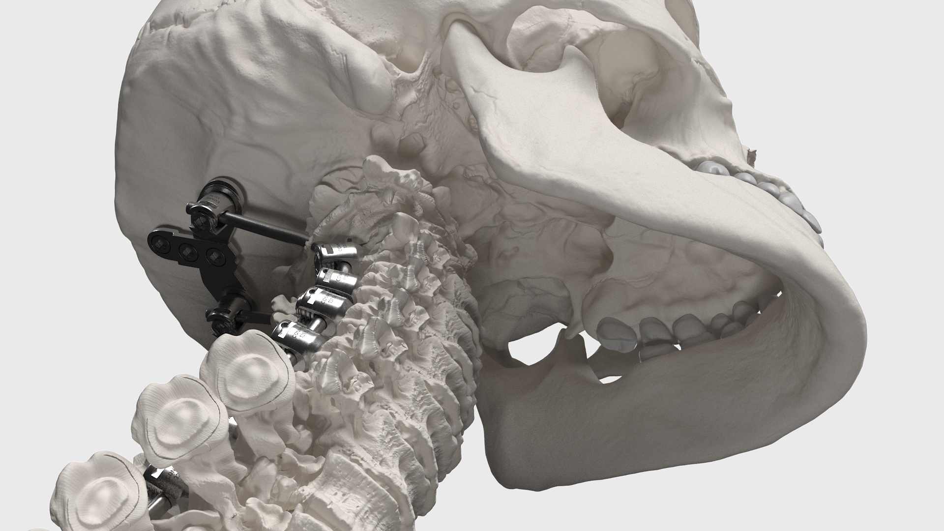 3D Bone Skull and Cervical Spine Fixation model