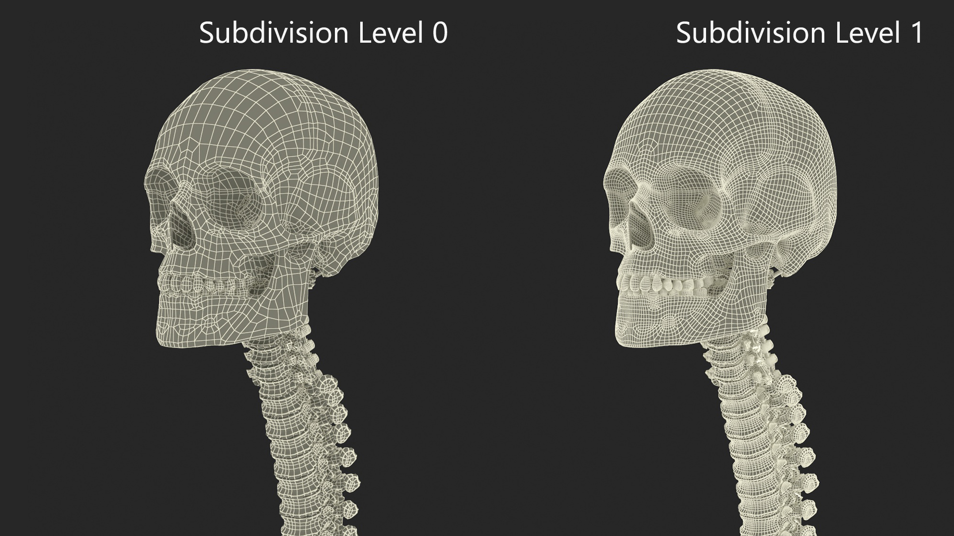 3D Bone Skull and Cervical Spine Fixation model