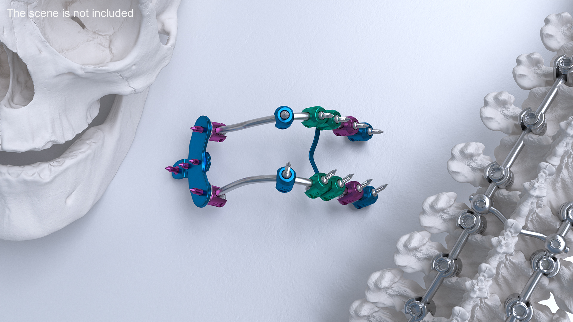 3D Posterior Cervical Spine Fixation System Colored model