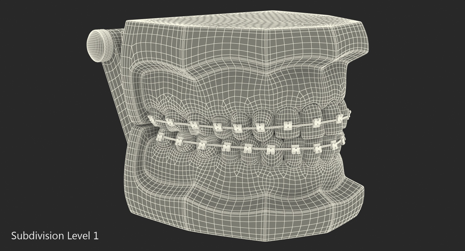 3D model Transparent Dental Typodont With Bracket and Dental Implants