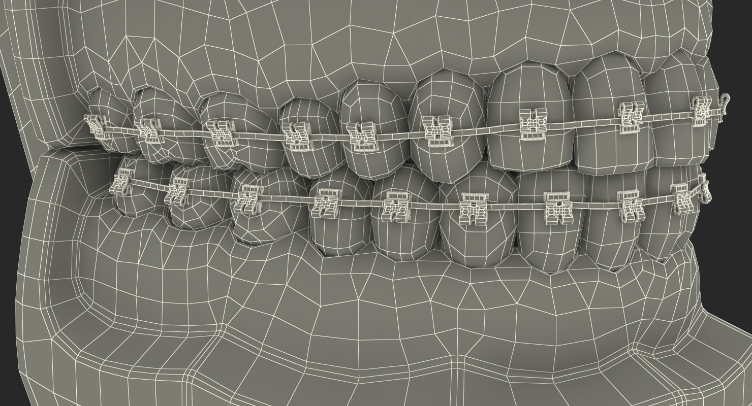 3D model Transparent Dental Typodont With Bracket and Dental Implants