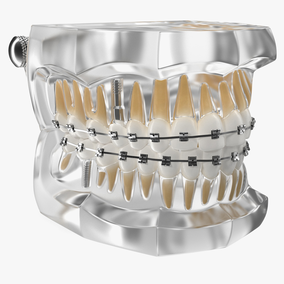 Transparent Dental Typodont With Bracket and Dental Implants