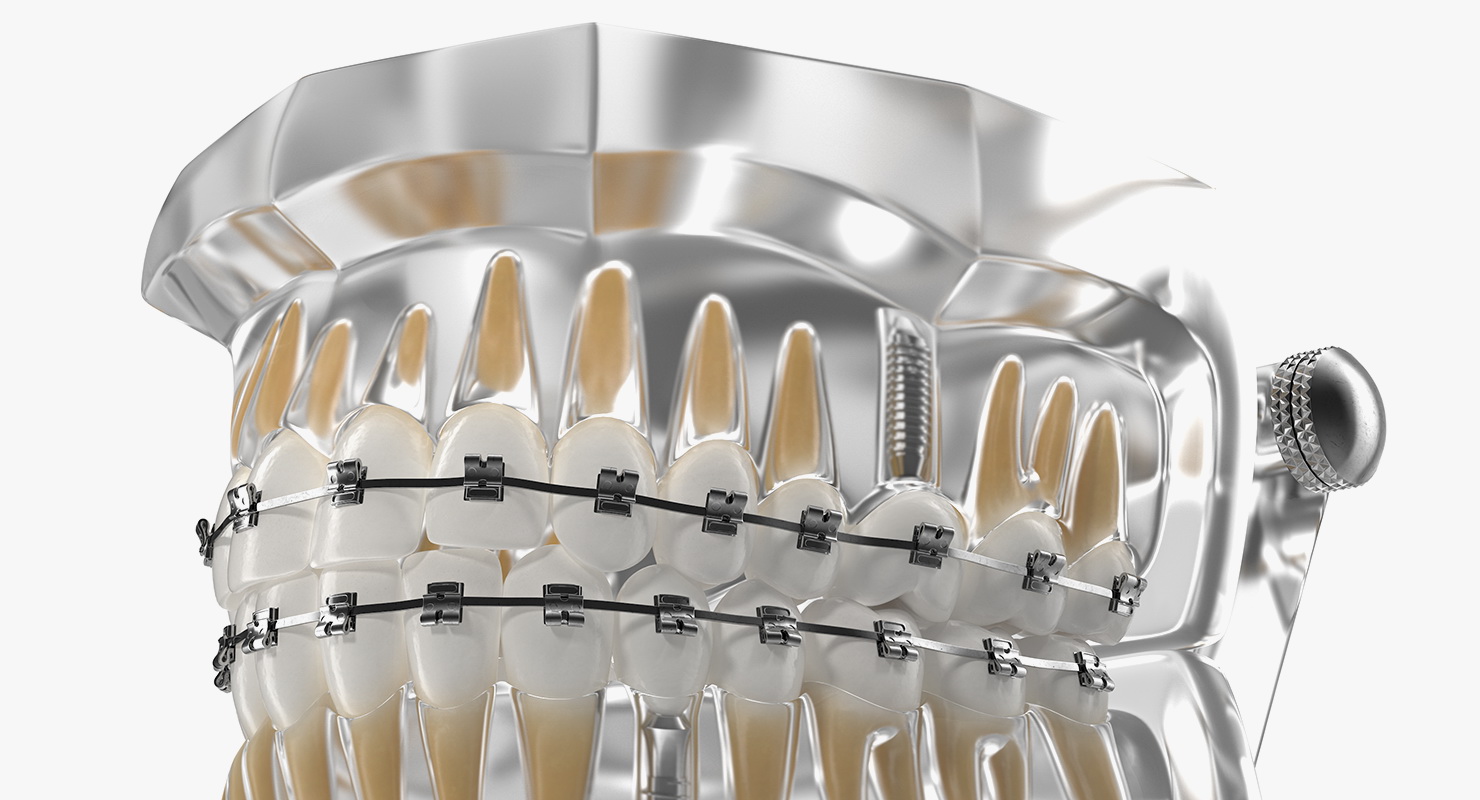 3D model Transparent Dental Typodont With Bracket and Dental Implants