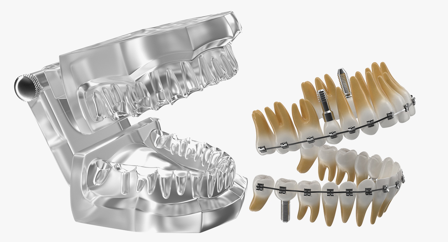 3D model Transparent Dental Typodont With Bracket and Dental Implants