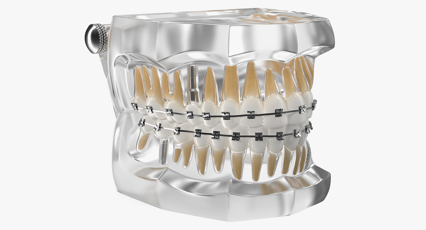 3D model Transparent Dental Typodont With Bracket and Dental Implants
