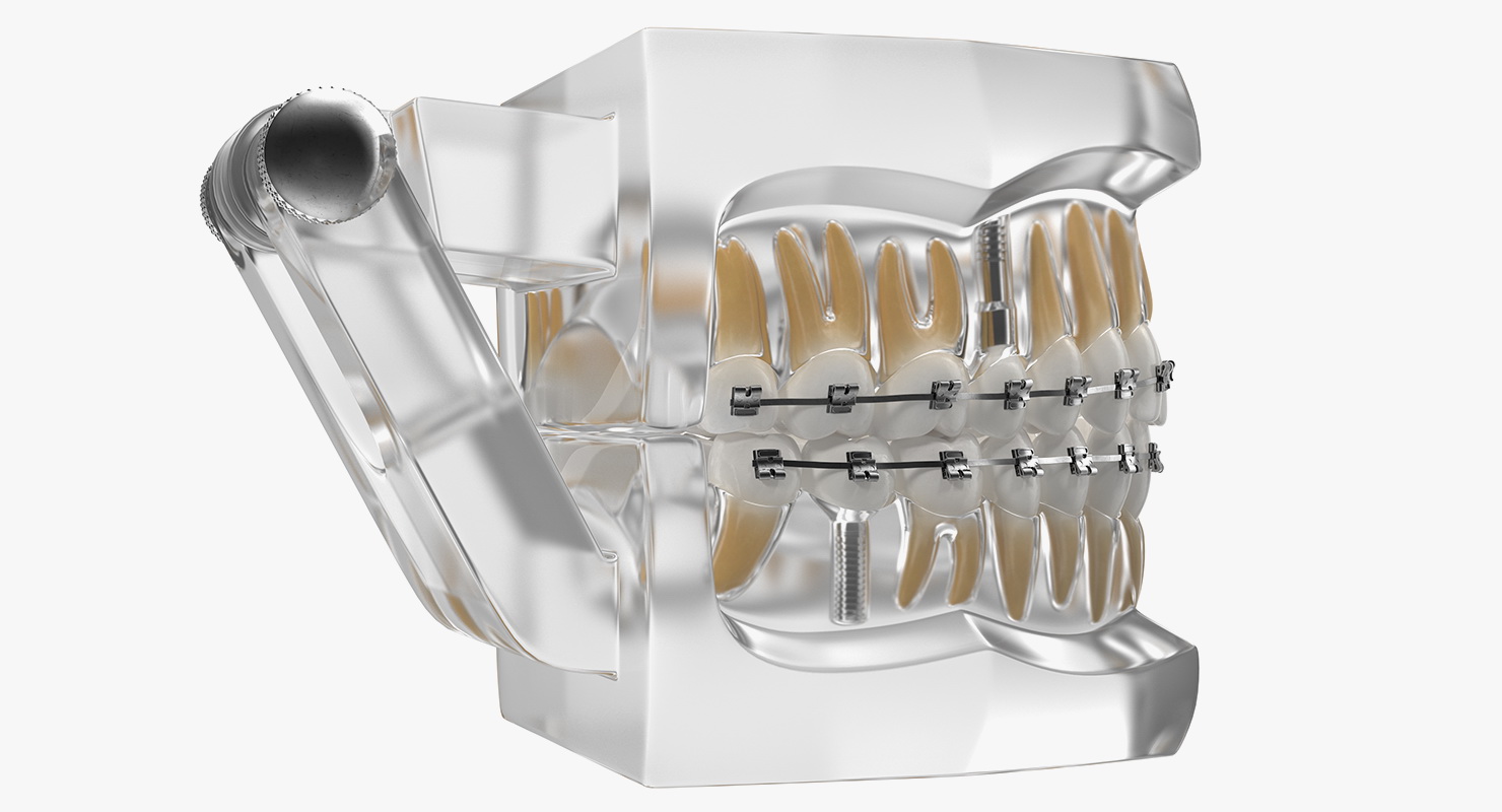 3D model Transparent Dental Typodont With Bracket and Dental Implants