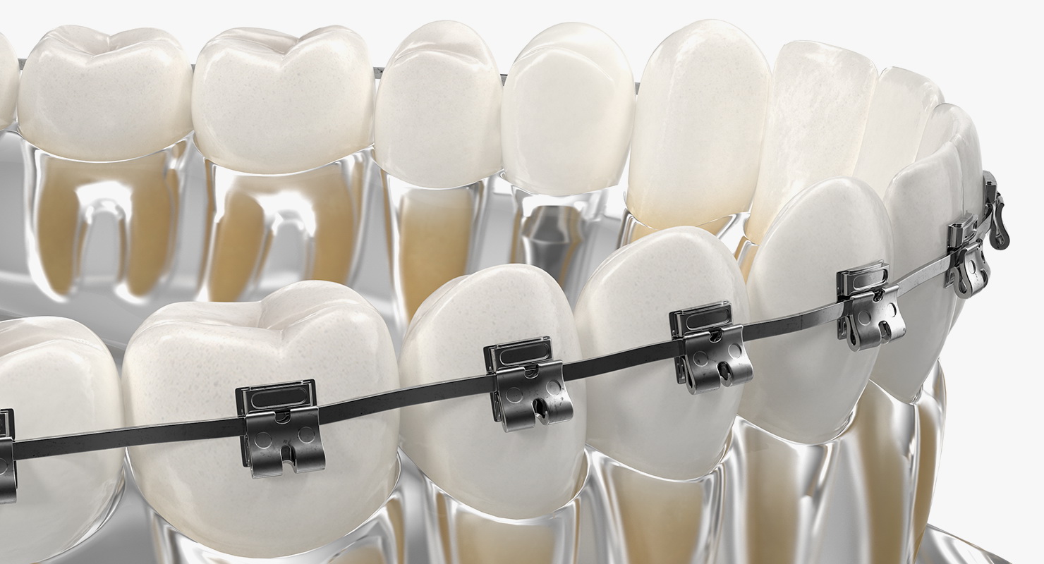 3D model Transparent Dental Typodont With Bracket and Dental Implants