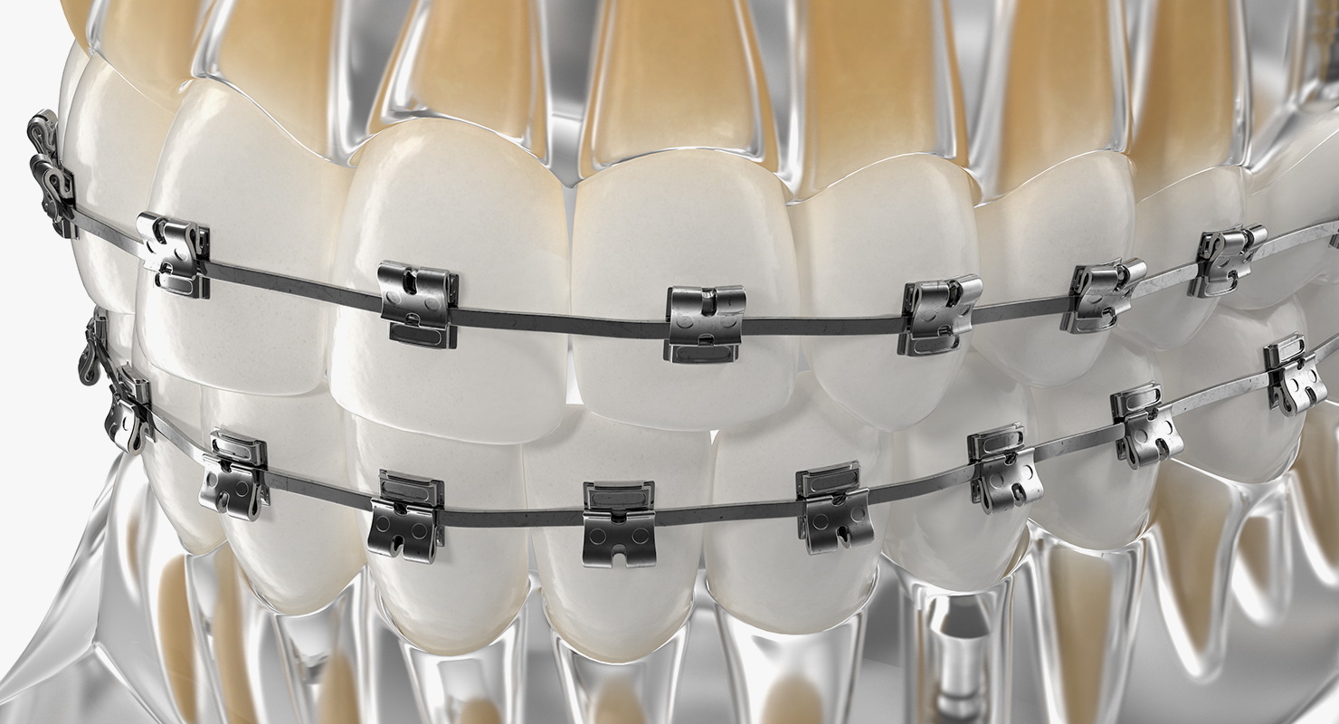 3D model Transparent Dental Typodont With Bracket and Dental Implants