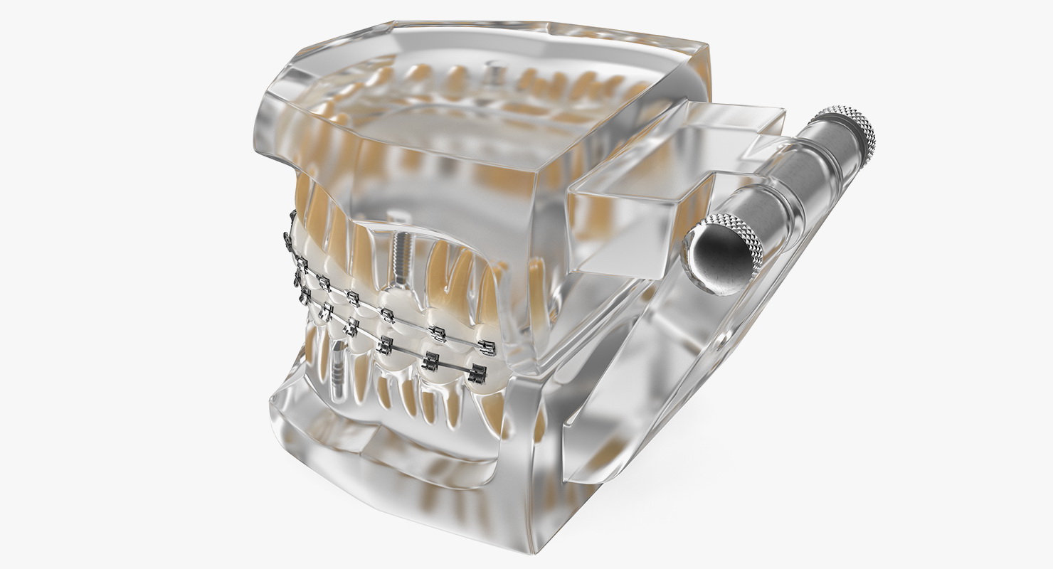 3D model Transparent Dental Typodont With Bracket and Dental Implants