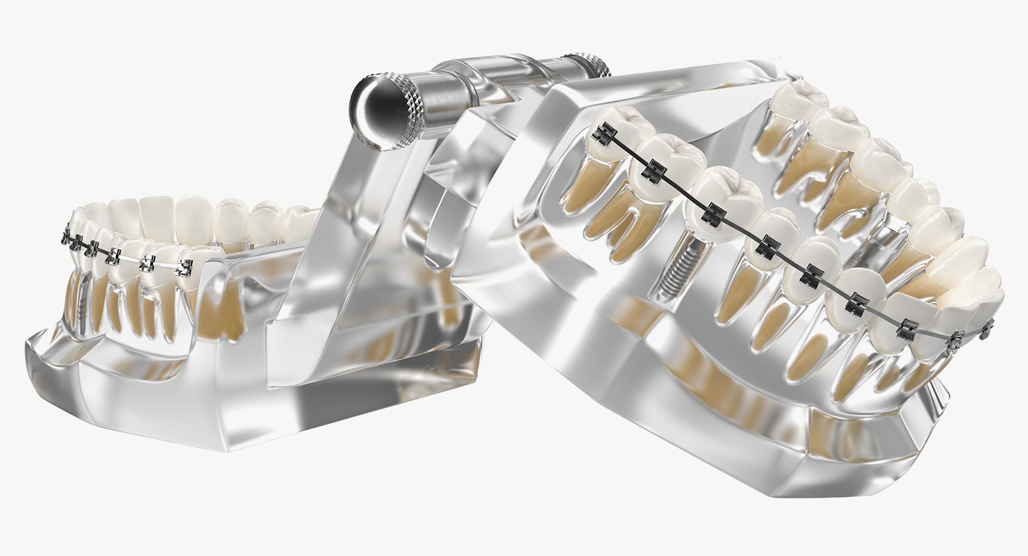 3D model Transparent Dental Typodont With Bracket and Dental Implants