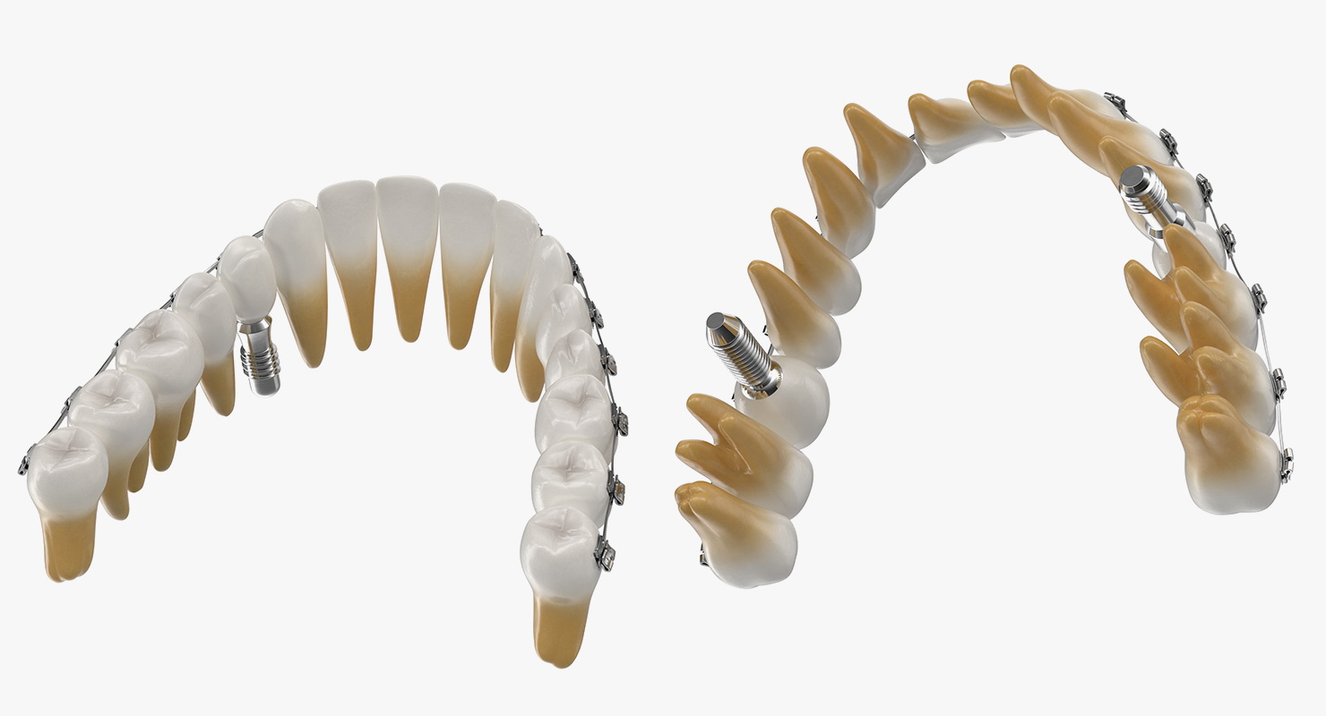 3D model Transparent Dental Typodont With Bracket and Dental Implants
