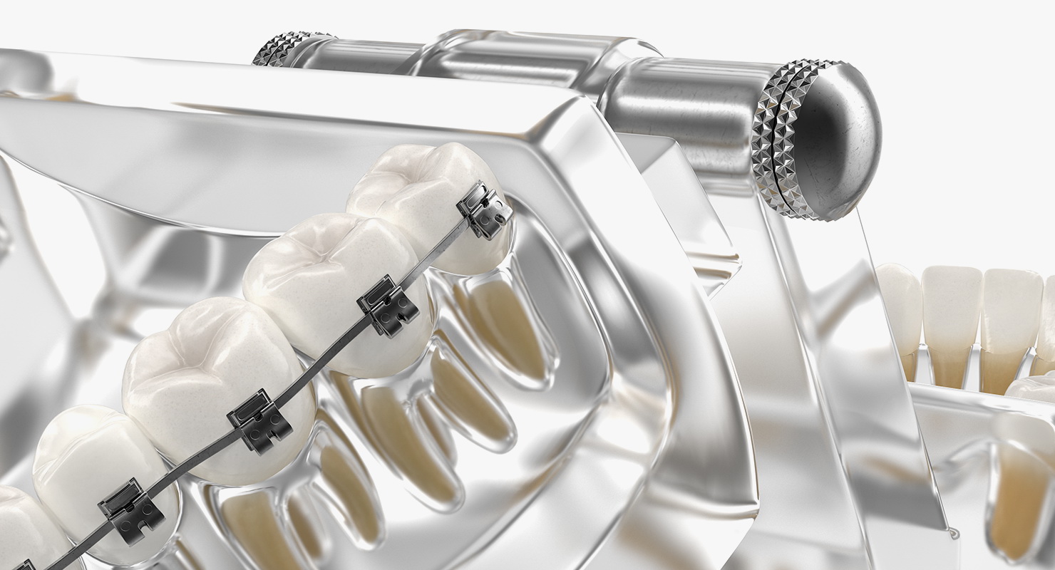 3D model Transparent Dental Typodont With Bracket and Dental Implants