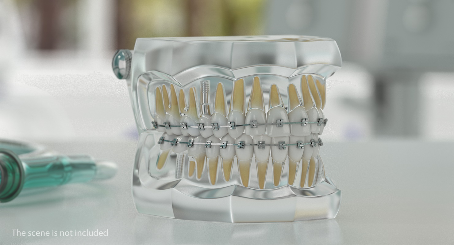 3D model Transparent Dental Typodont With Bracket and Dental Implants