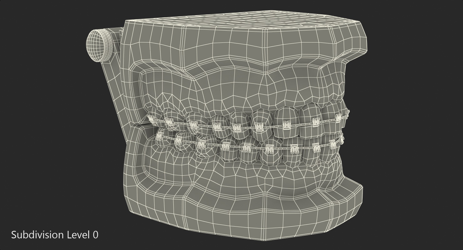 3D model Transparent Dental Typodont With Bracket and Dental Implants