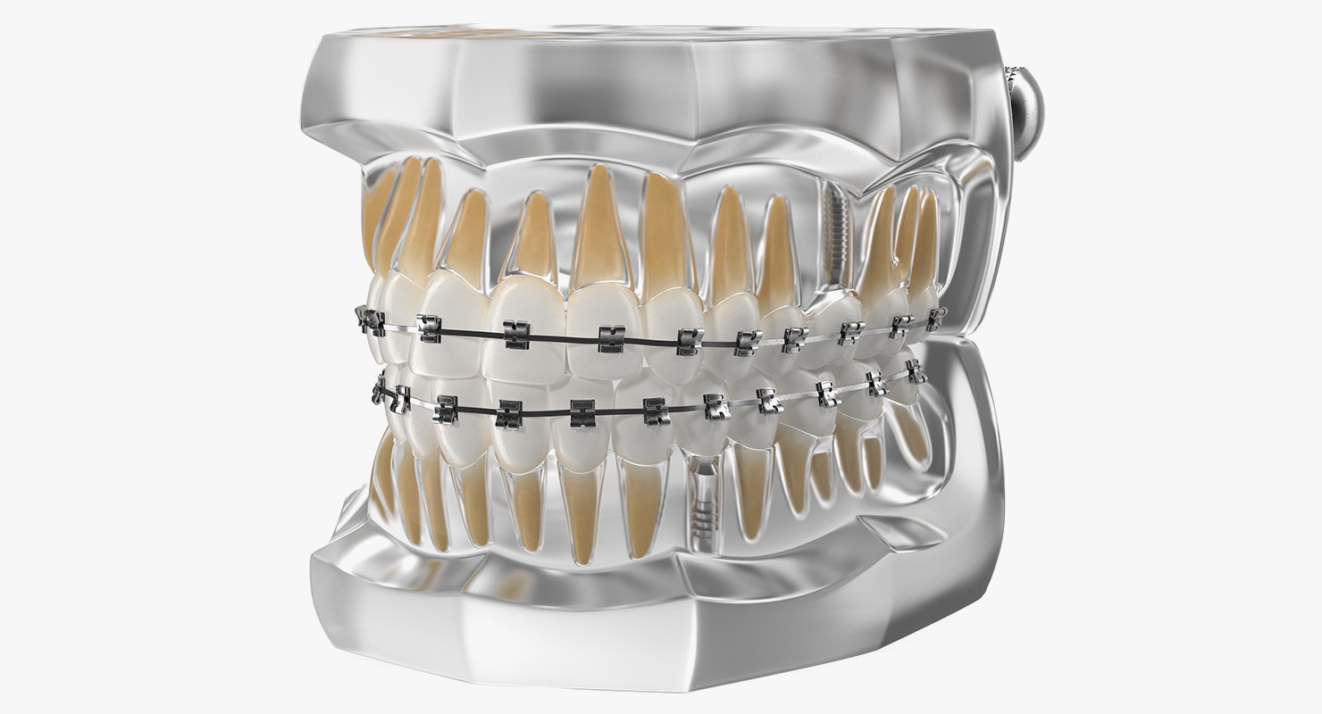 3D model Transparent Dental Typodont With Bracket and Dental Implants