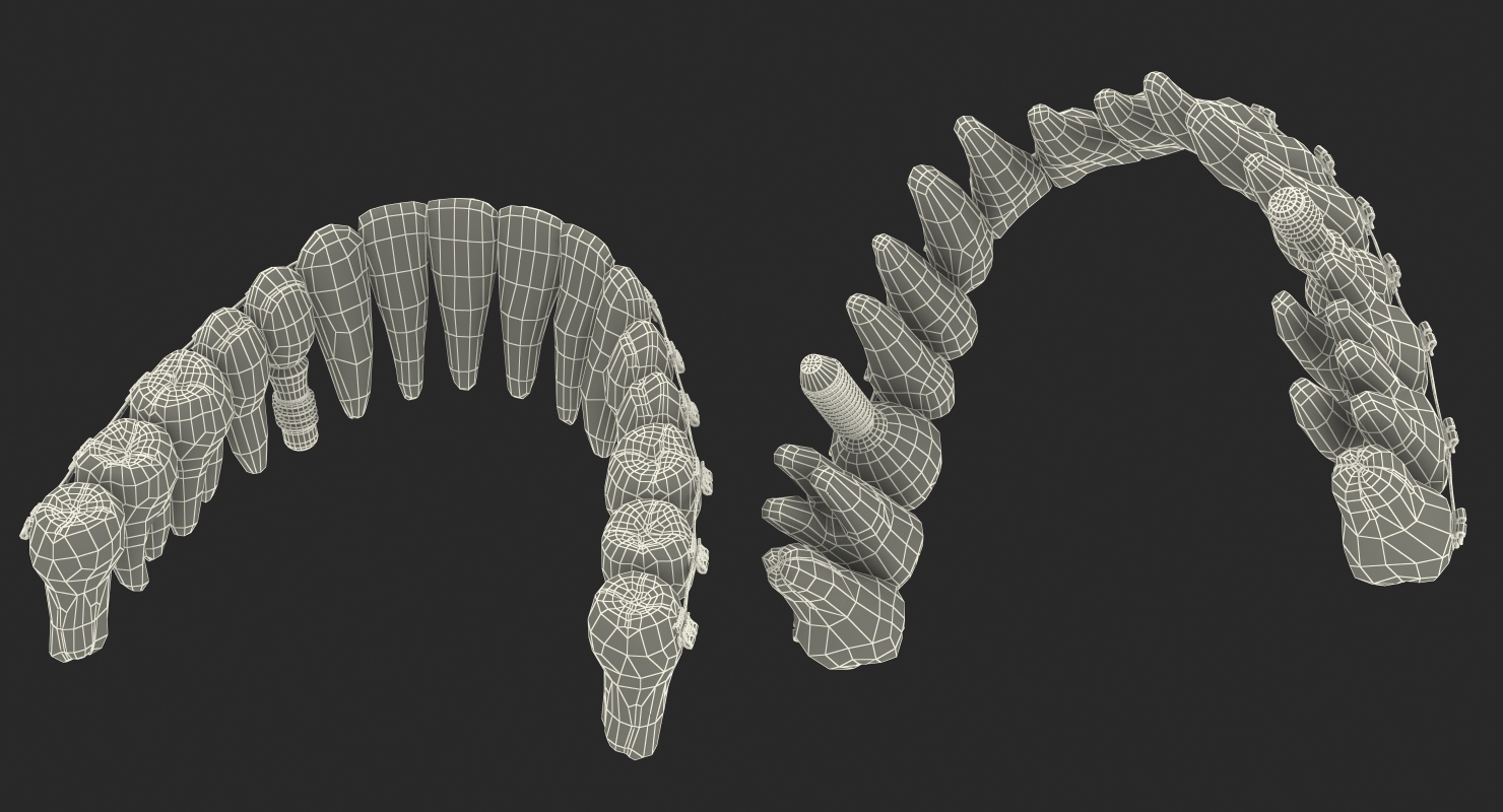 3D model Transparent Dental Typodont With Bracket and Dental Implants