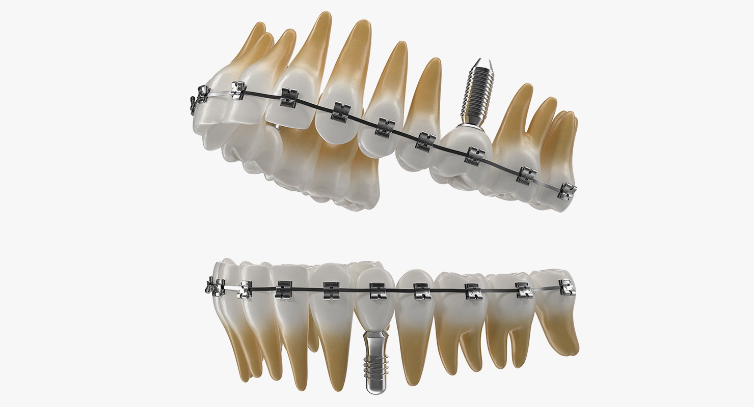 3D model Transparent Dental Typodont With Bracket and Dental Implants