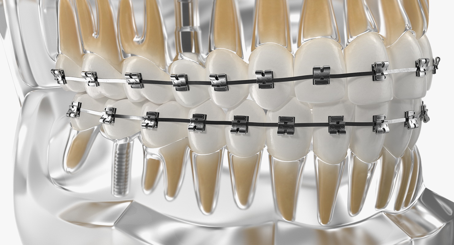 3D model Transparent Dental Typodont With Bracket and Dental Implants