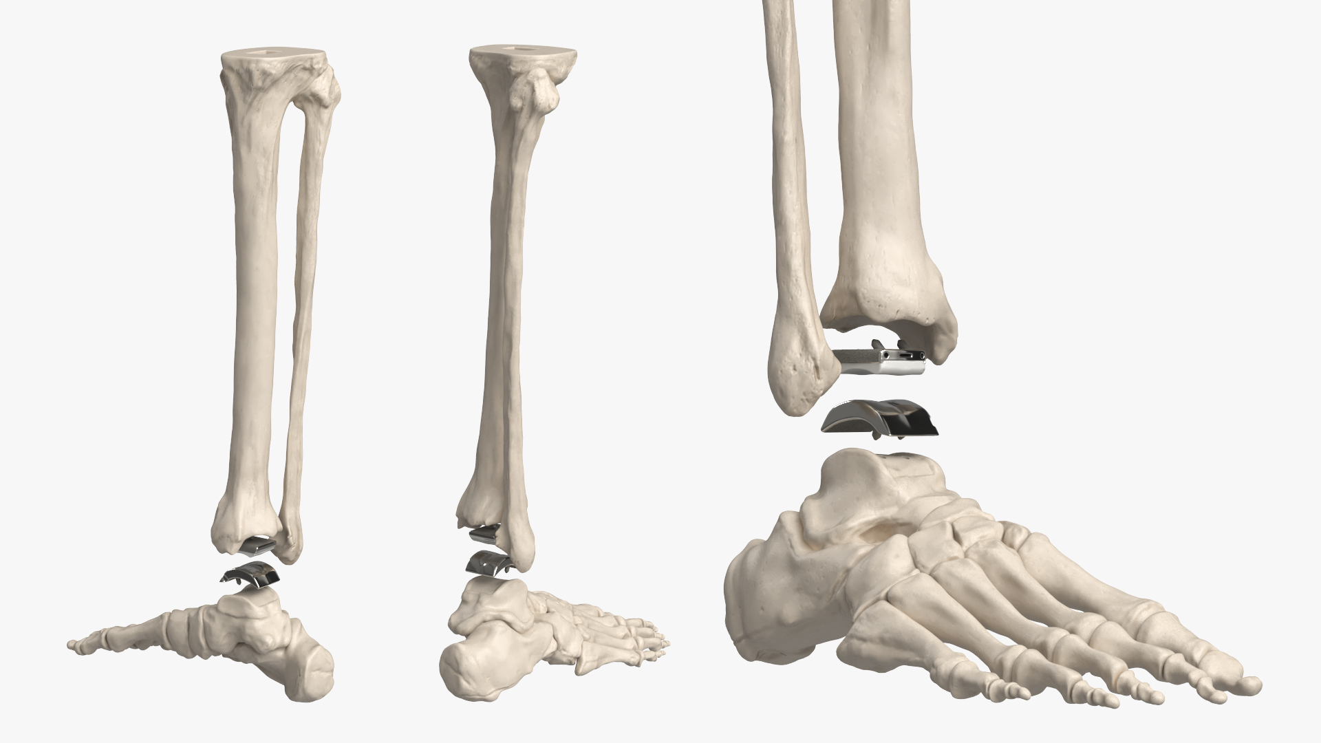 Ankle Joint Implant with Tibia Fibula and Foot Bones, view 3
