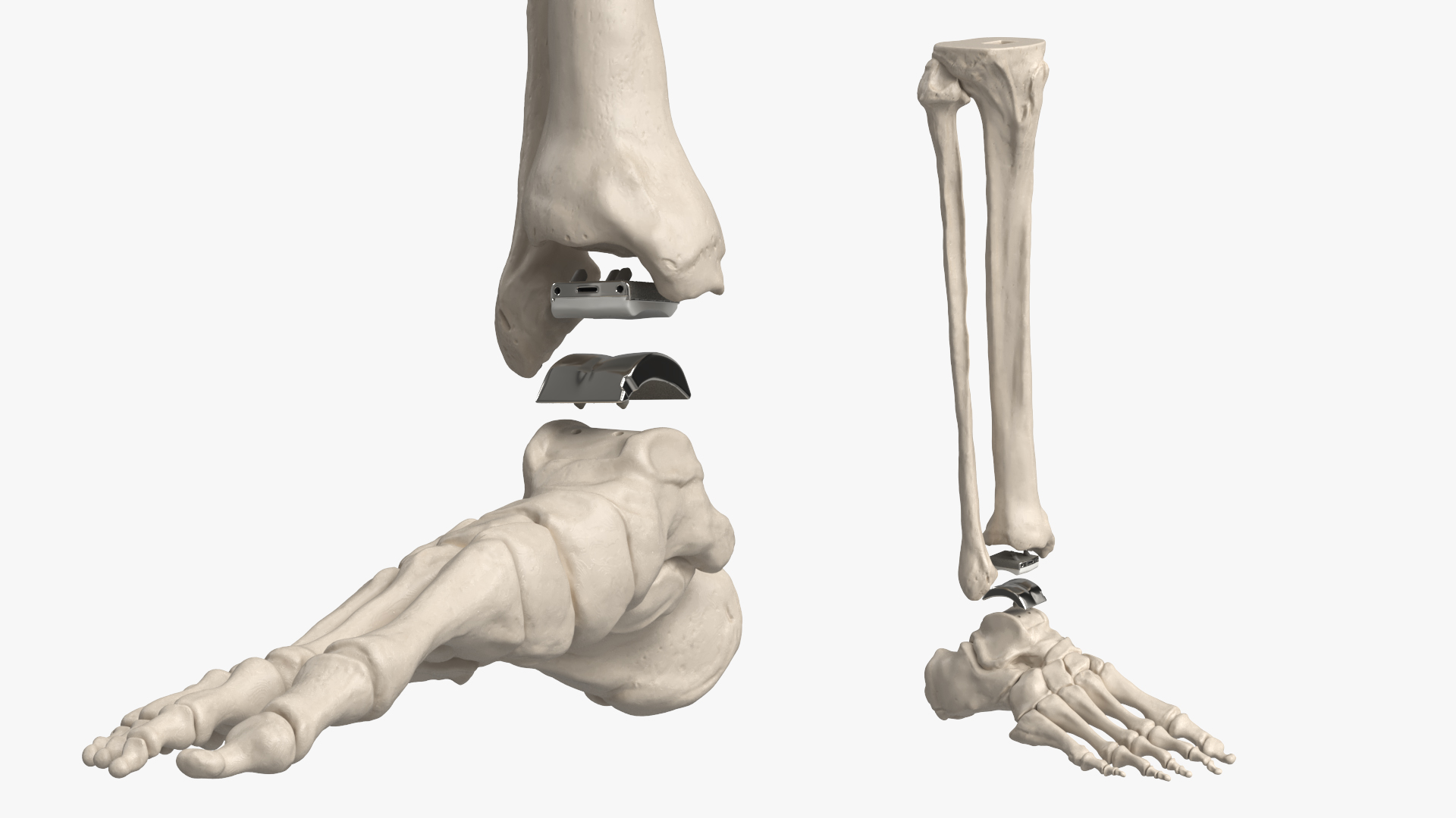 Ankle Joint Implant with Tibia Fibula and Foot Bones