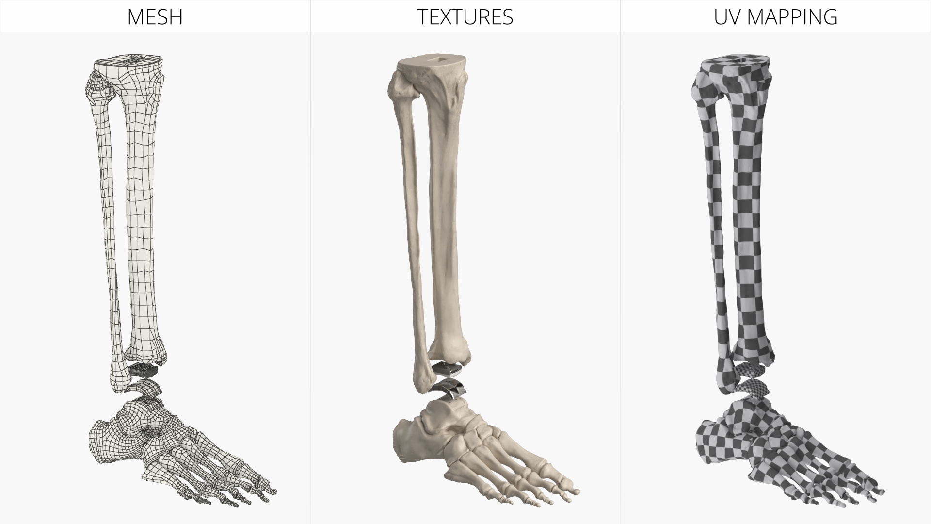 Ankle Joint Implant with Tibia Fibula and Foot Bones, view 9