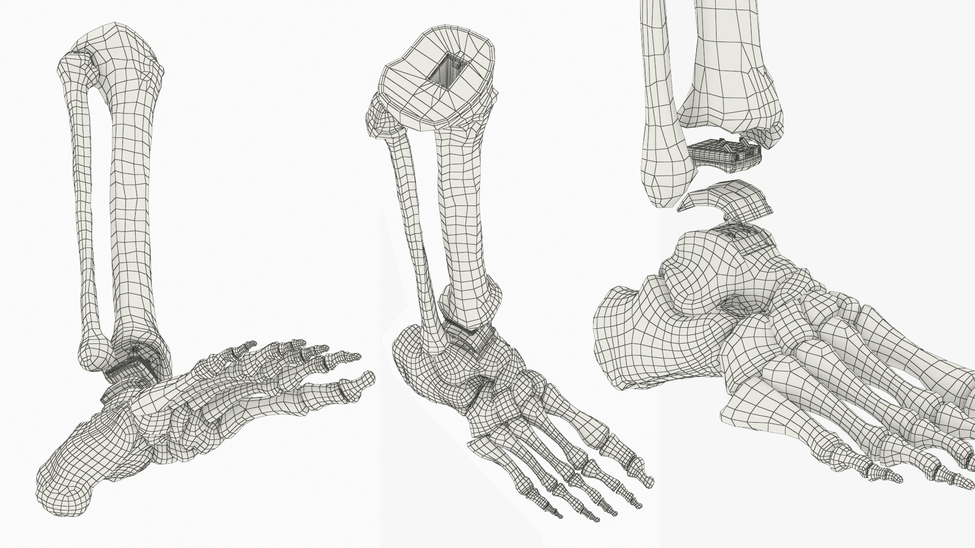 Ankle Joint Implant with Tibia Fibula and Foot Bones, view 12