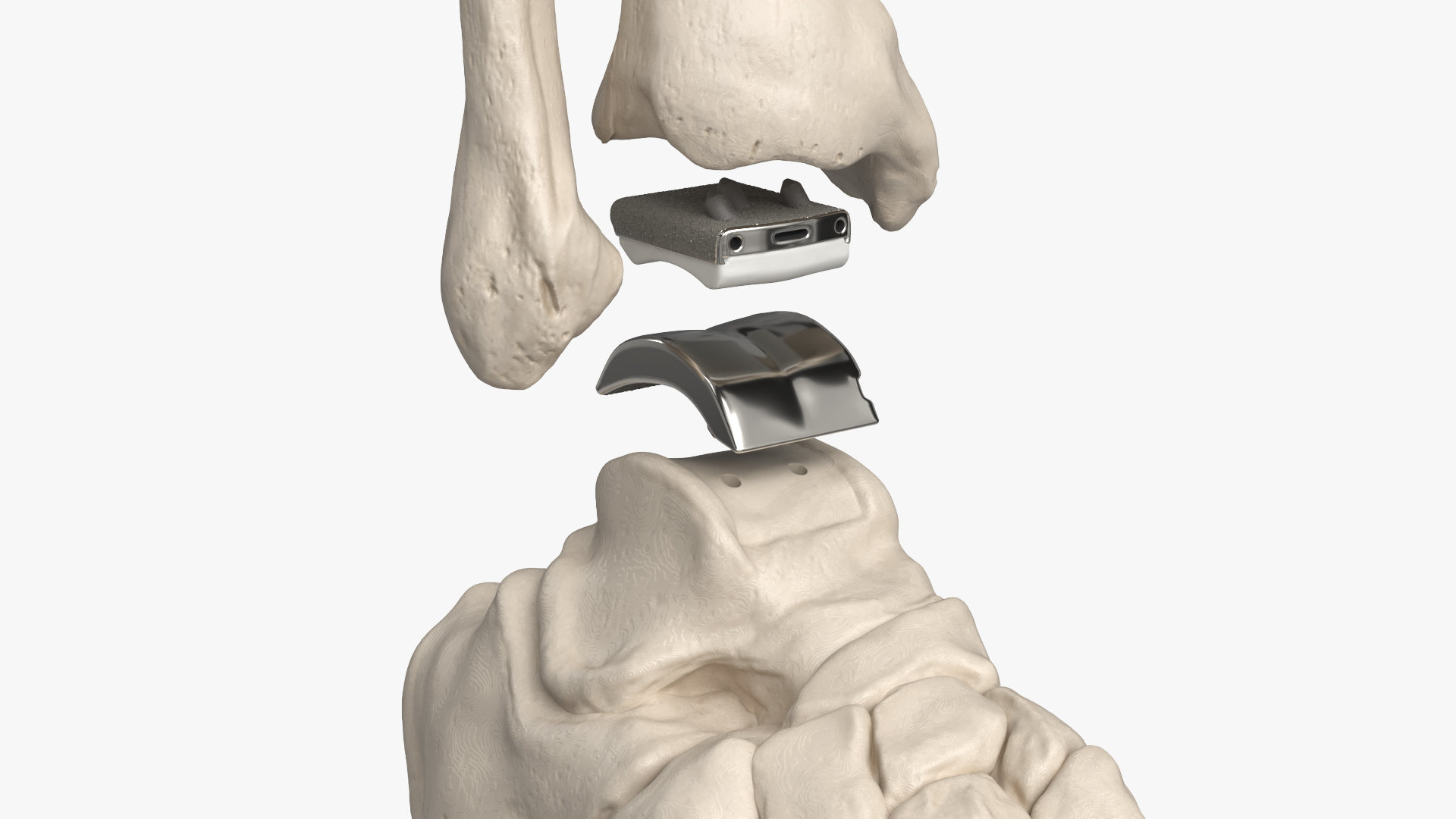 Ankle Joint Implant with Tibia Fibula and Foot Bones, view 7