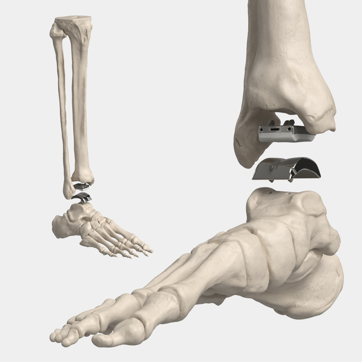 Ankle Joint Implant with Tibia Fibula and Foot Bones