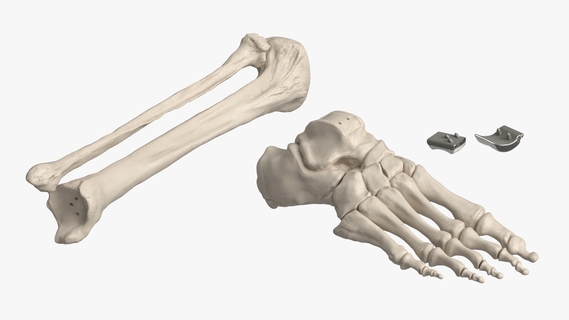 Ankle Joint Implant with Tibia Fibula and Foot Bones, view 6