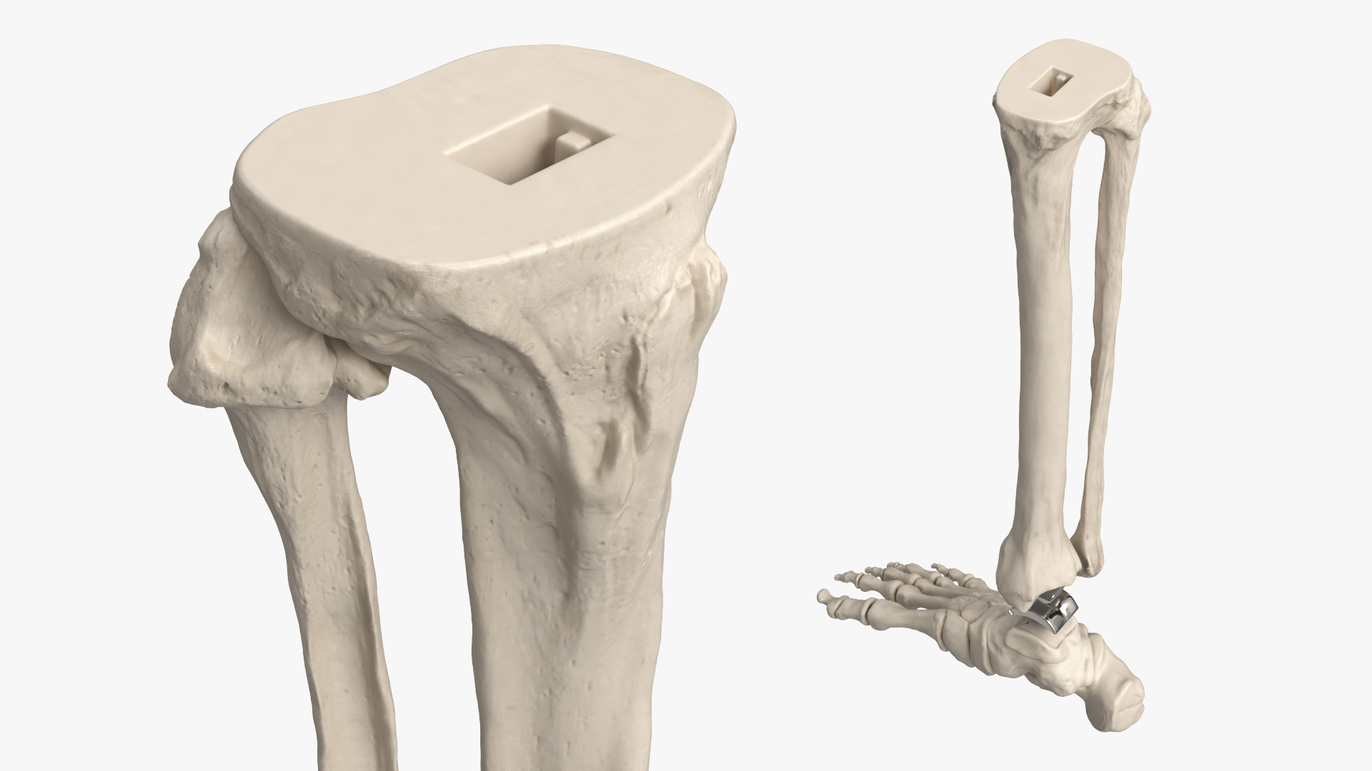 Ankle Joint Implant with Tibia Fibula and Foot Bones, view 4