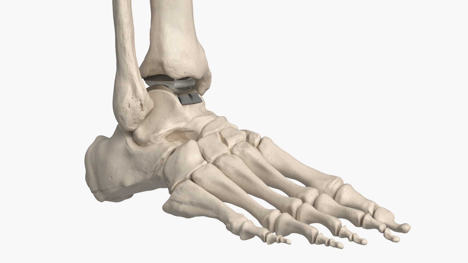 Ankle Joint Implant with Tibia Fibula and Foot Bones, view 8