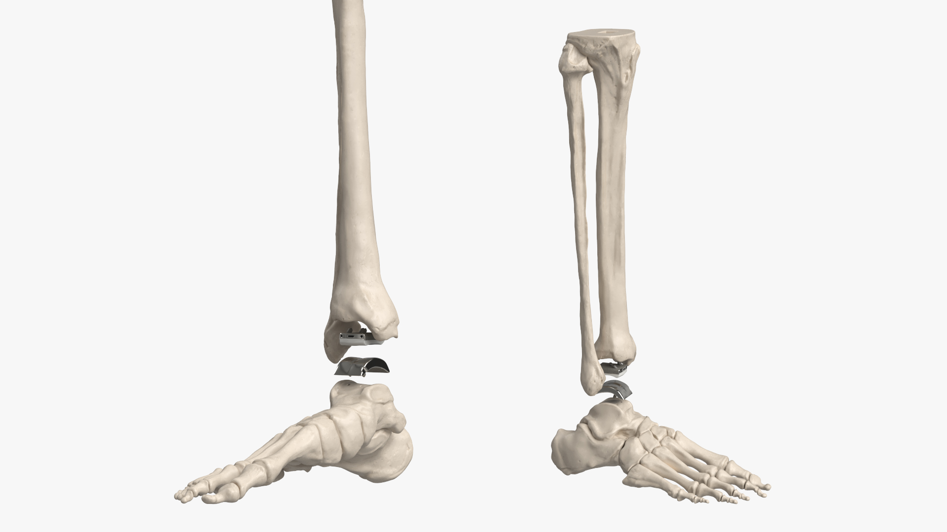Ankle Joint Implant with Tibia Fibula and Foot Bones, view 5