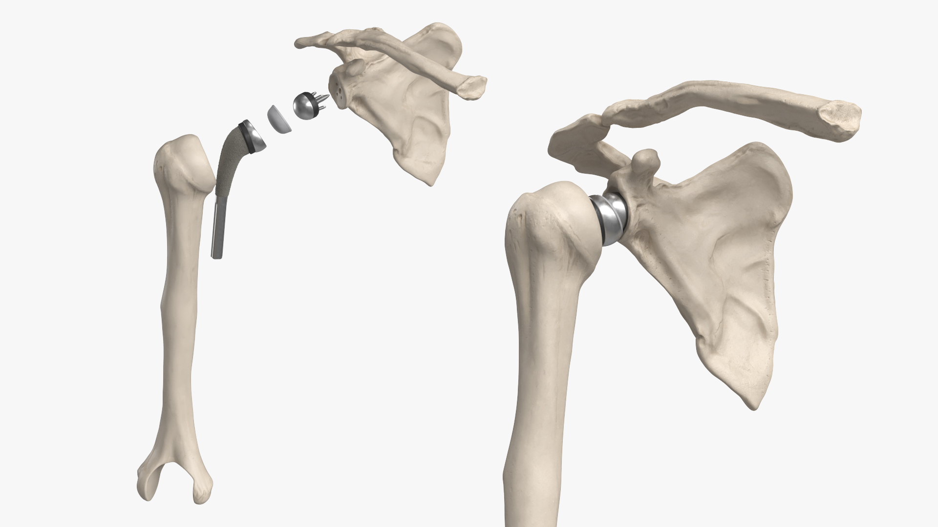 Male Skeleton with Joint Implants Ivory, view 7