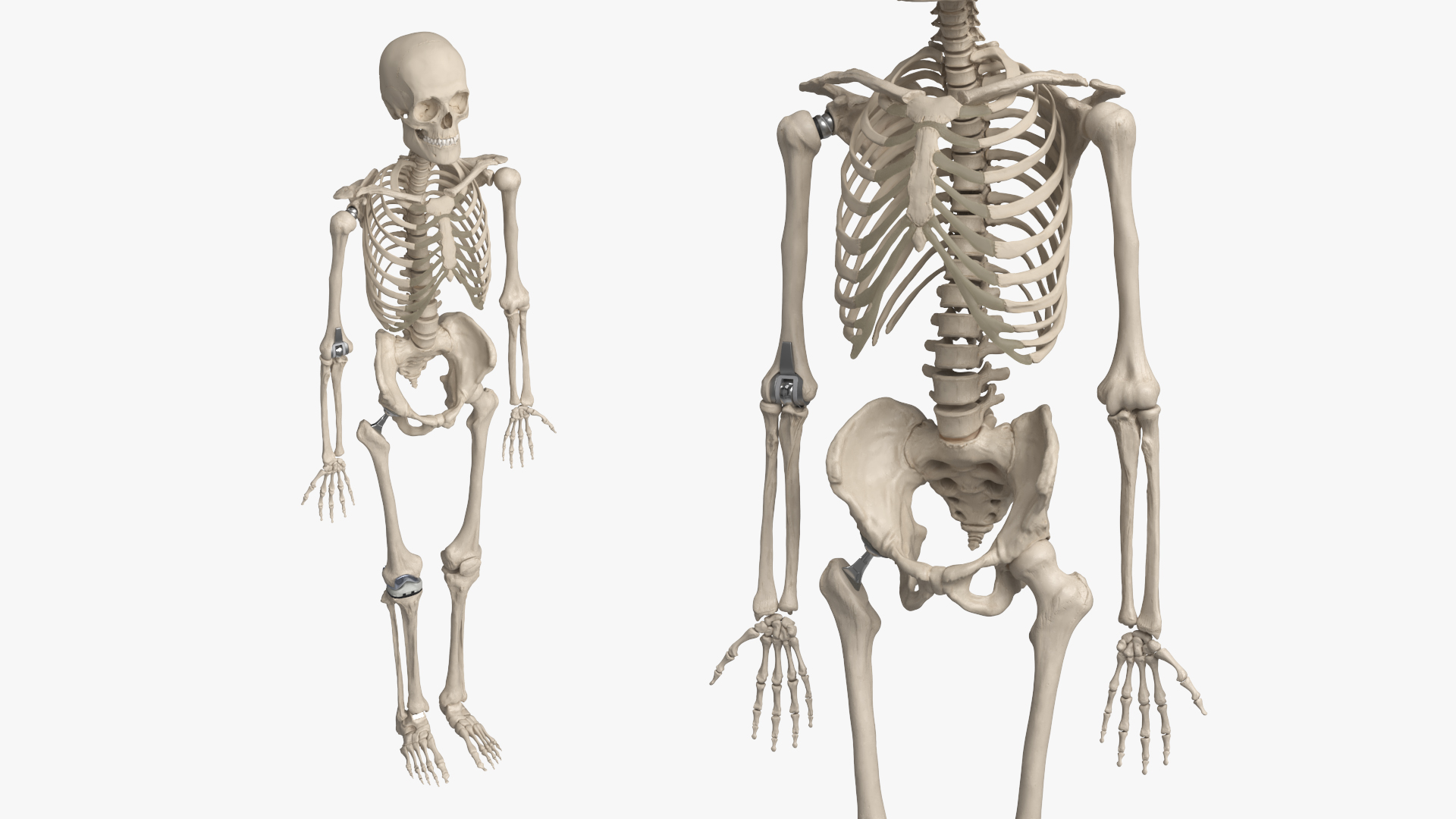 Male Skeleton with Joint Implants Ivory, view 5