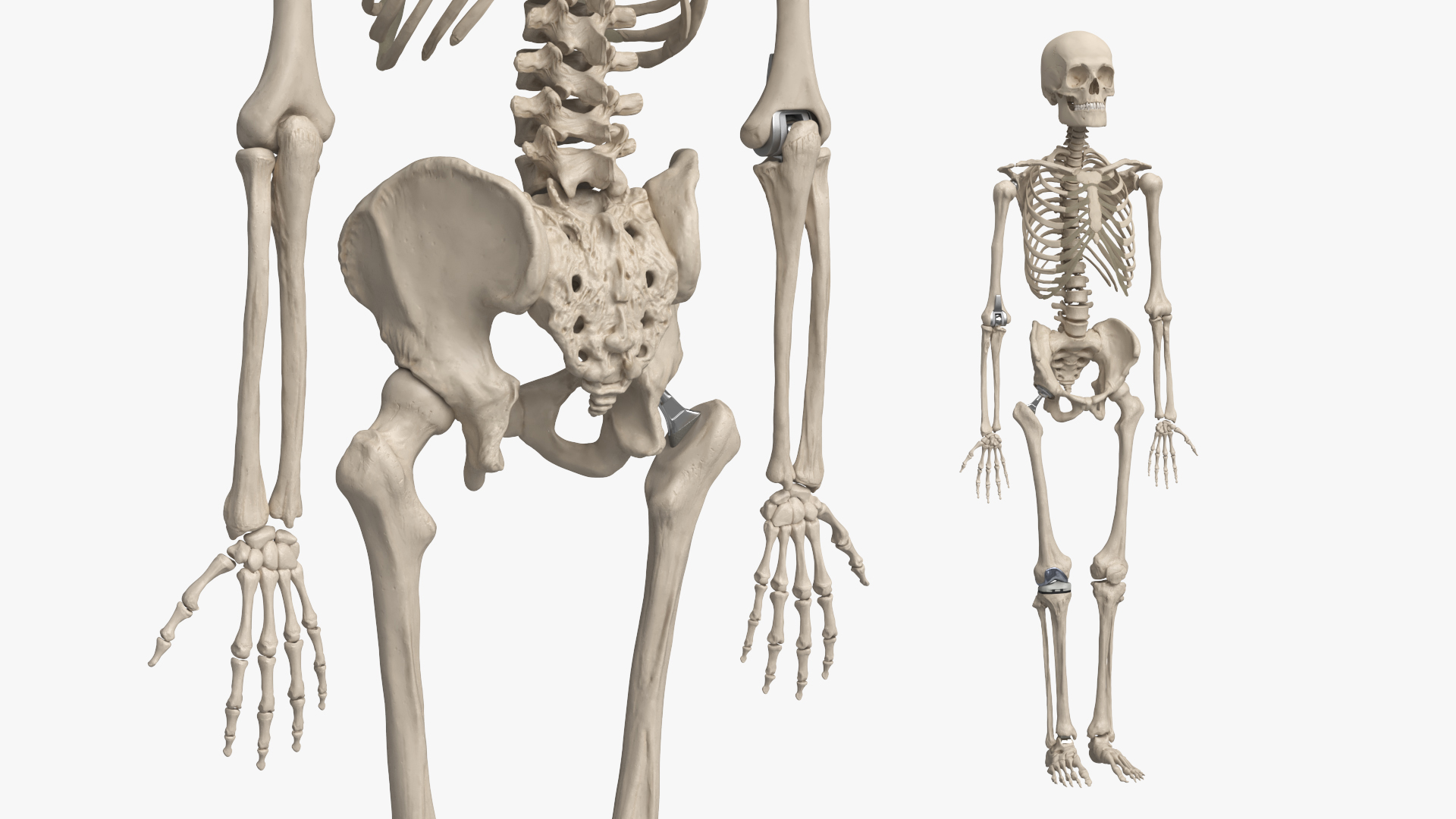 Male Skeleton with Joint Implants Ivory