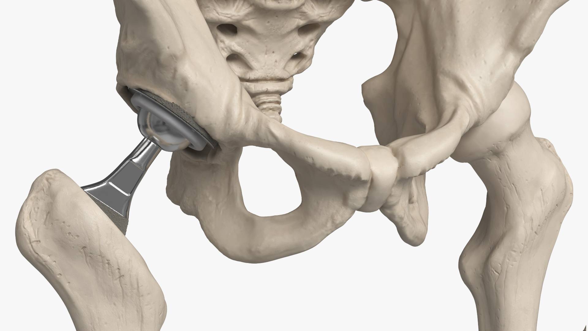 Male Skeleton with Joint Implants Ivory, view 12