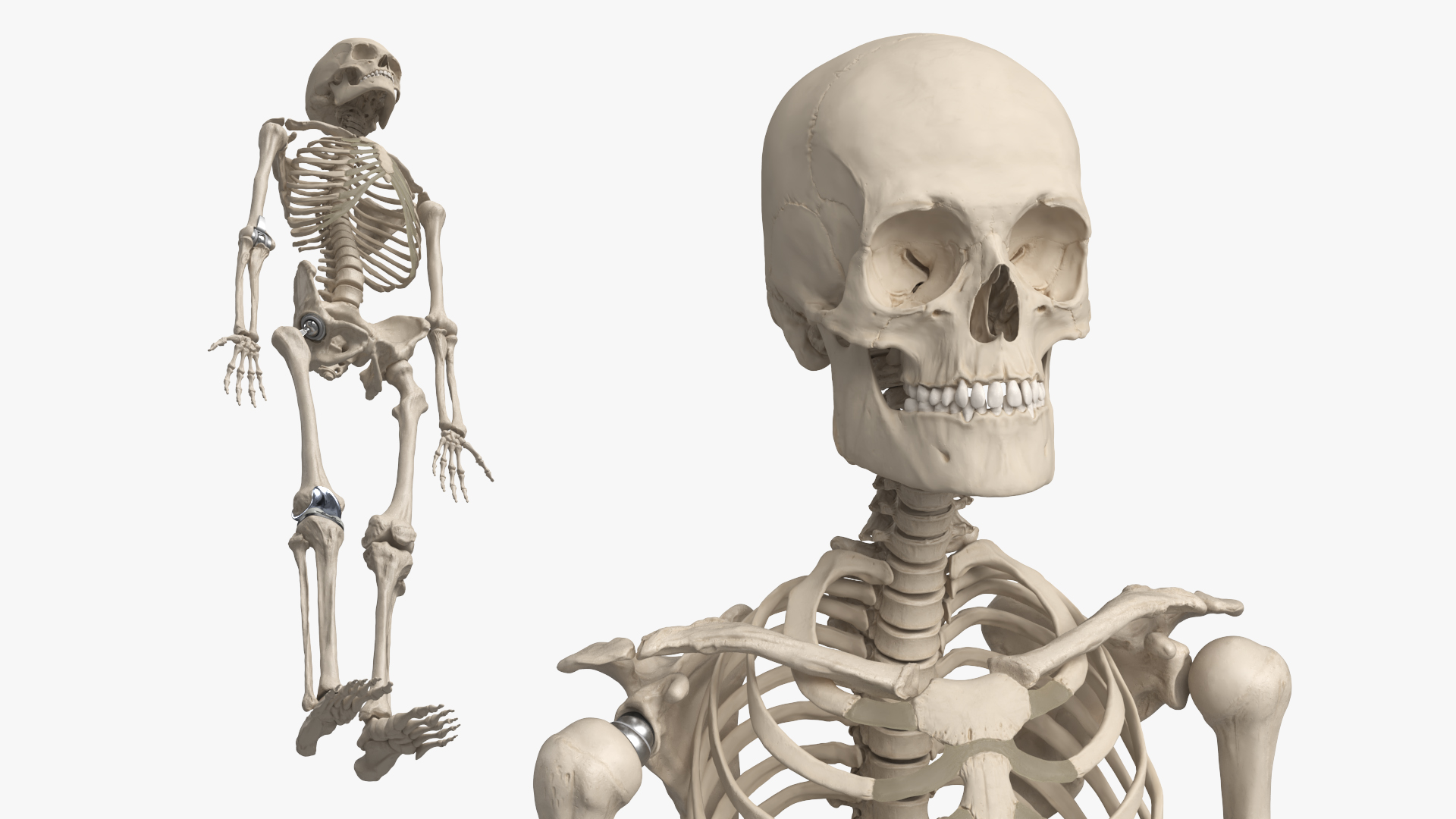 Male Skeleton with Joint Implants Ivory, view 3