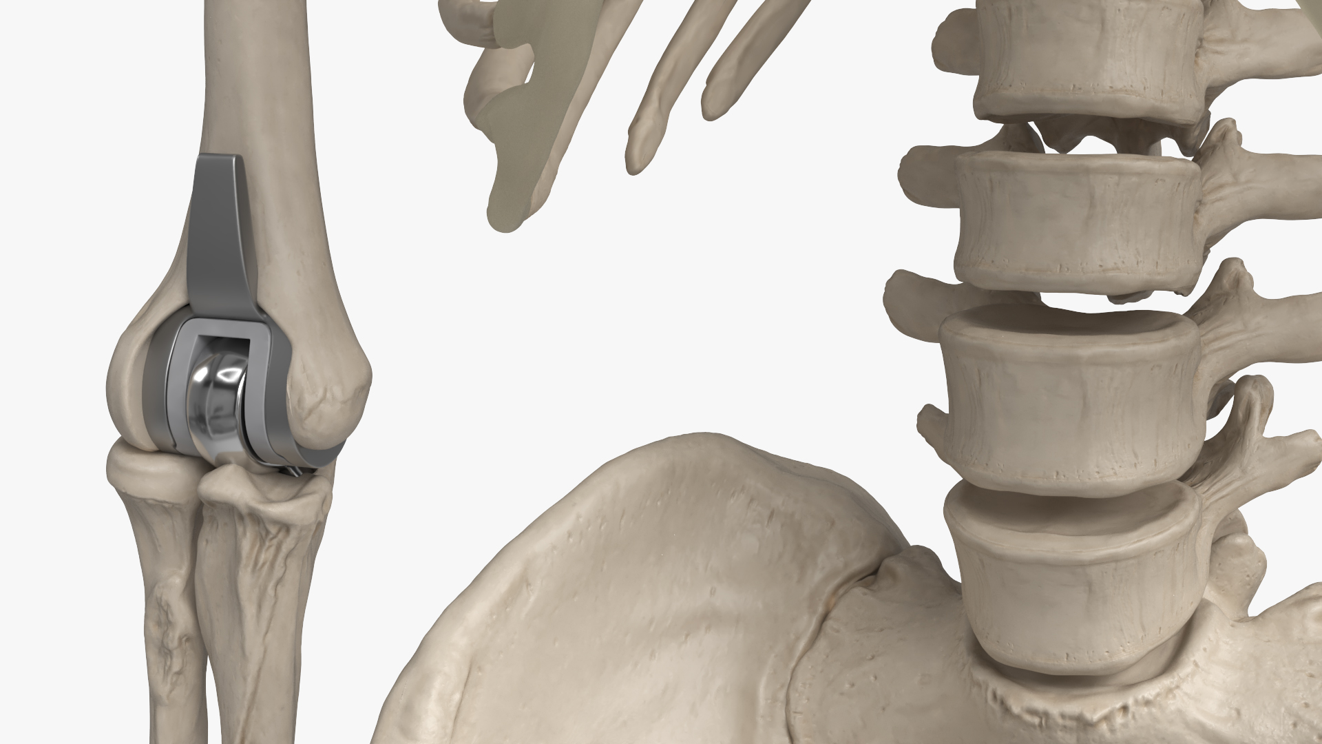 Male Skeleton with Joint Implants Ivory, view 9