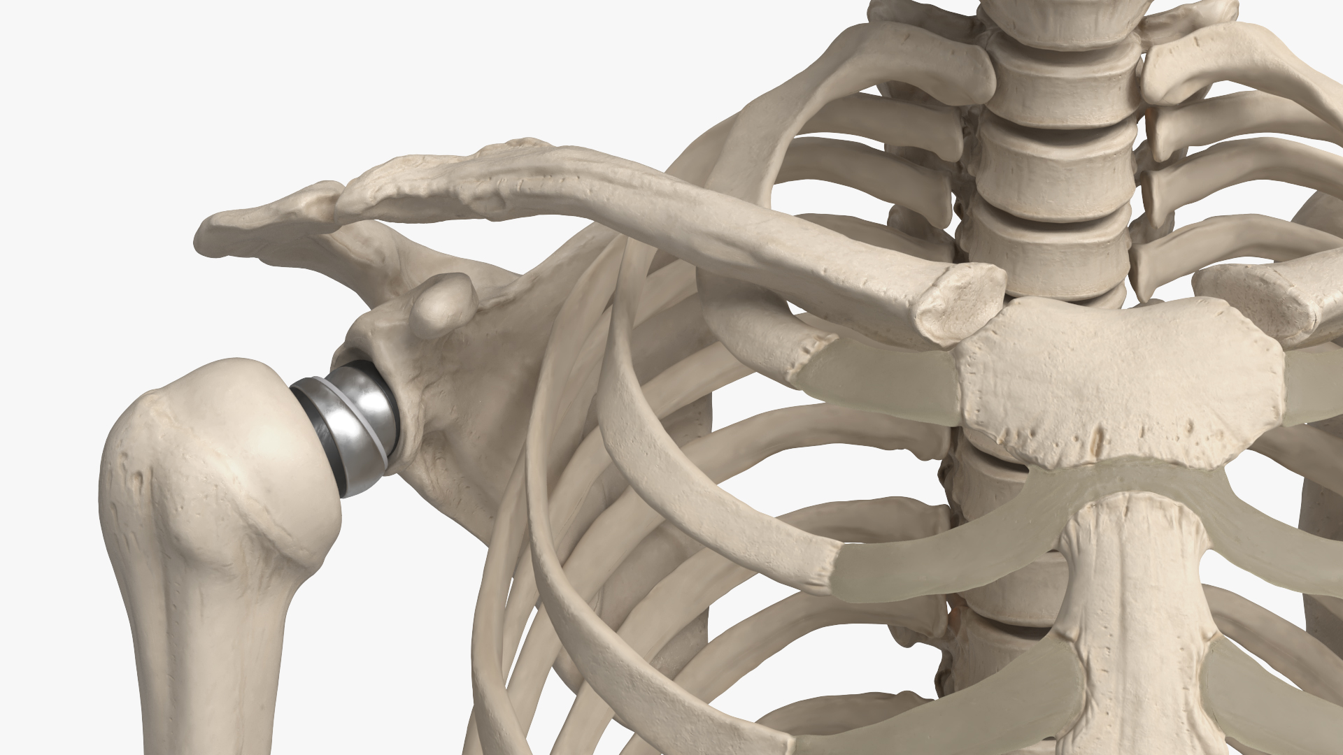 Male Skeleton with Joint Implants Ivory, view 6