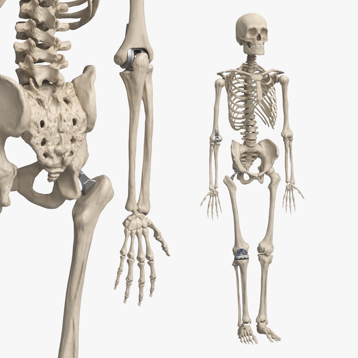 Male Skeleton with Joint Implants Ivory